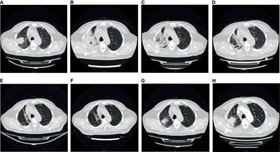 Immune-Related Multiple-Organs Injuries Following ICI Treatment With Tislelizumab in an Advanced Non-Small Cell Lung Cancer Patient: A Case Report